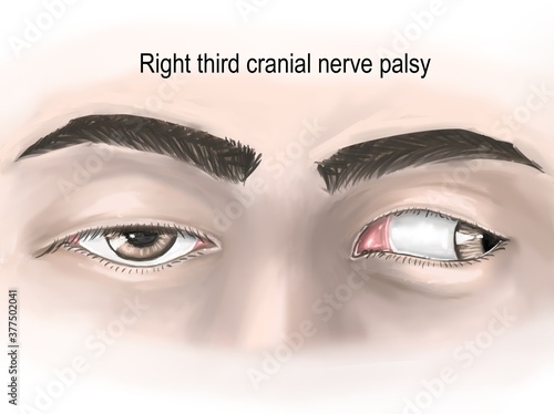 Photos right third cranial nerve palsy was demonstrated with medial rectus palsy of right eye