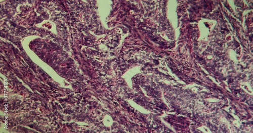 Carcinoma of the stomach in cross section under the microscope 100x photo