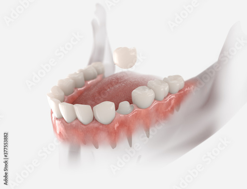 Dental crown placement process. 3d illustration on whit background.