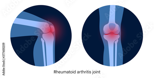 Arthritis in knee joint