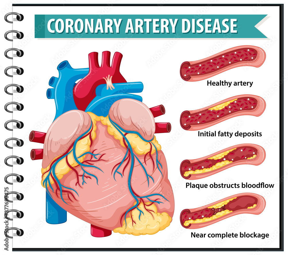 Coronary Artery Disease for health education Infographic Stock Vector