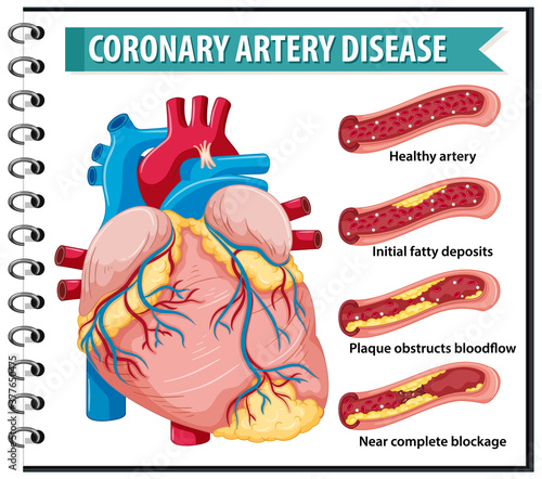 Coronary Artery Disease for health education Infographic
