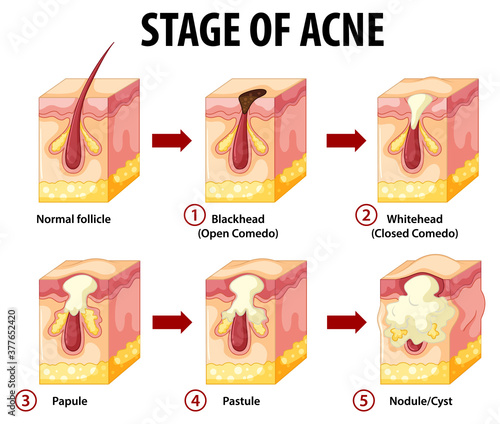 Stages of skin acne anatomy