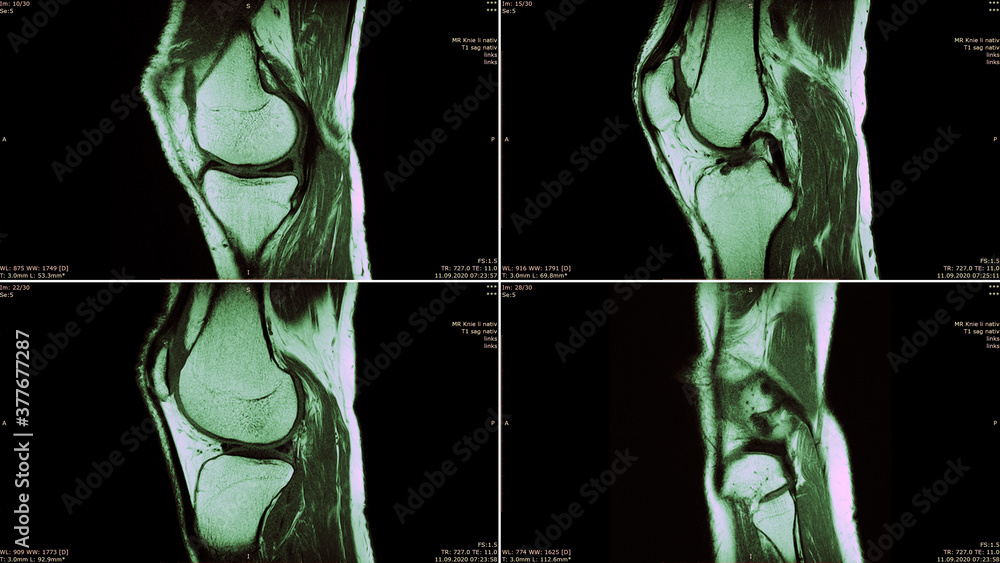 Radiologie: Vier MRT-Aufnahmen eines männlichen Knies - mit Meniskusriss - obrazy, fototapety, plakaty 