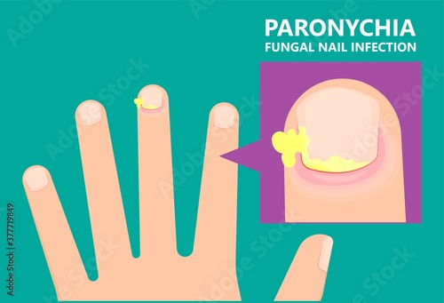 skin finger nail toes symptom injuries pus drain treatment treat fluid relieve heal wound fungal surgery hand feet Fungus felon onychia clubbing abscess thick ragged crack bed fungi Athlete's foot