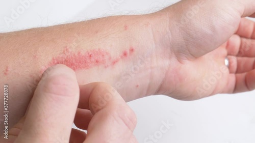 Poison ivy on forearm being scratched and rubbed.  Itchy red allergic reaction, close up on skin.