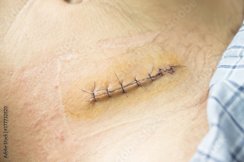 фотографія Nurse or Doctor hand treating the wound patient to clean the wound after stitches patients appendectomy surgery