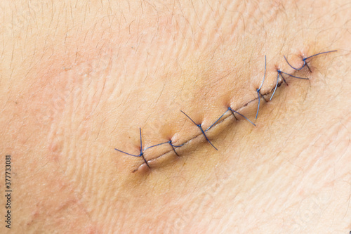 Foto Nurse or Doctor hand treating the wound patient to clean the wound after stitches patients appendectomy surgery
