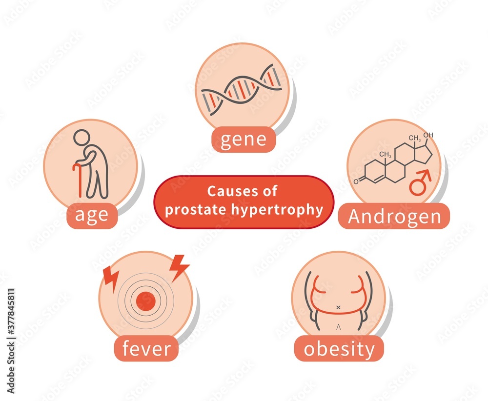 Five causes of male prostate hypertrophy and inflammation, gene, old age, obesity, inflammation, androgen isolated on white background