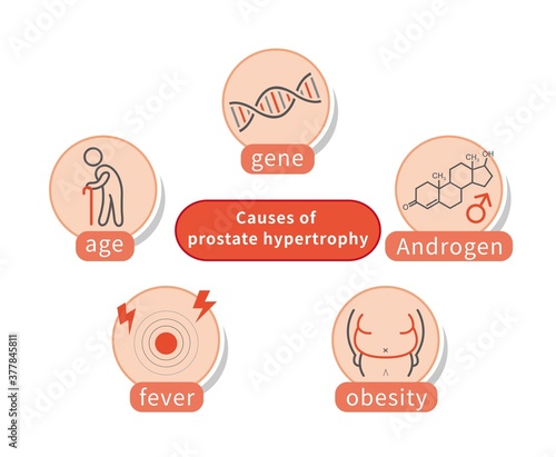 Five causes of male prostate hypertrophy and inflammation, gene, old age, obesity, inflammation, androgen isolated on white background