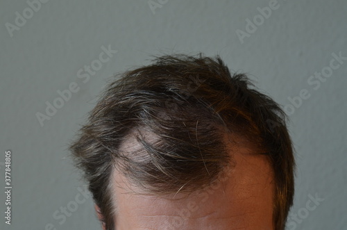 Φωτογραφία Hair loss man. Close up on male scalp lossing hair.