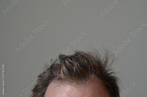 Hair loss man. Close up on male scalp lossing hair.