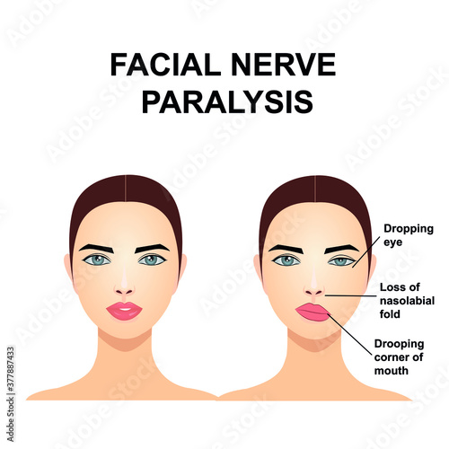 Paralysis of the facial nerve. Bell's palsy.