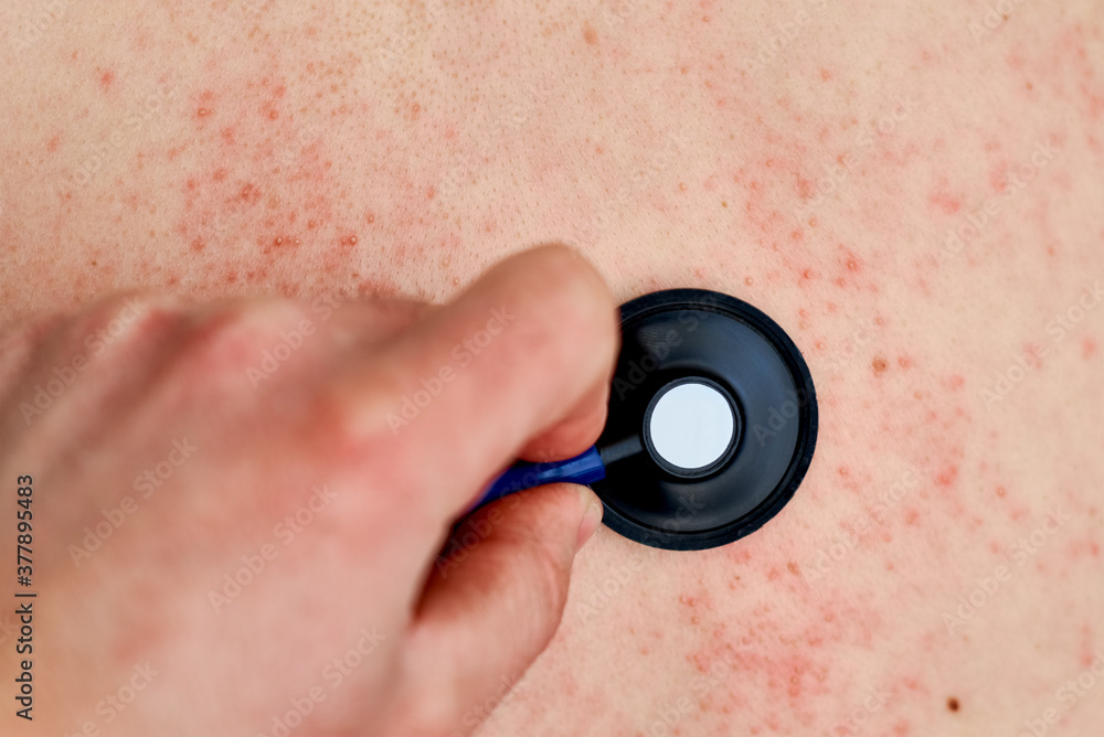 Fototapeta premium Allergic rash on skin. Woman with dermatology problem on back skin
