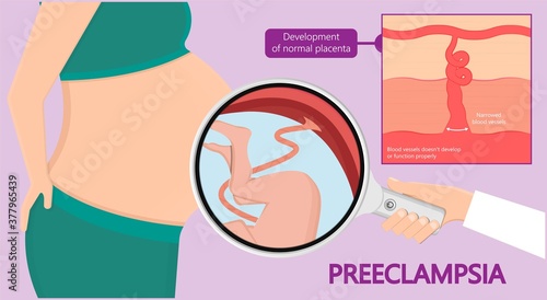 Preeclampsia pregnancy disorder hypertension toxemia urine risk birth care test check liver kidney fatal exam first trimester