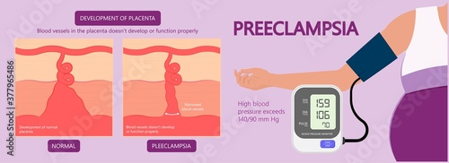Preeclampsia pregnancy disorder hypertension toxemia urine risk birth care test check liver kidney fatal exam first trimester