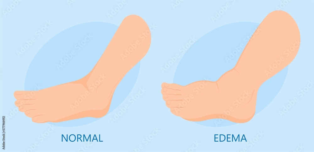 Edema swelling under the skin that affect with ankles and legs cirrhosis puffiness Stretched shiny dimple pits pressed deep vein thrombosis Edema swelling under the skin that affect with ankles and legs cirrhosis puffiness Stretched shiny dimple pits pressed deep vein thrombosis