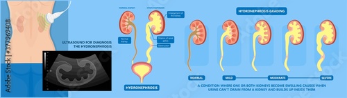 kidney damage UTI scan test tube VCUG acute VUR cyst exam flow pain birth block blood fetal fetus renal stone tract treat tumor urine x-ray cancer defect pelvic pelvis reflux sample system enlarge