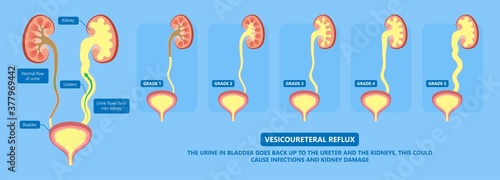 kidney damage UTI scan test tube VCUG acute VUR cyst exam flow pain birth block blood fetal fetus renal stone tract treat tumor urine x-ray cancer defect pelvic pelvis reflux sample system enlarge