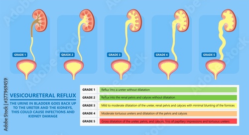 kidney damage UTI scan test tube VCUG acute VUR cyst exam flow pain birth block blood fetal fetus renal stone tract treat tumor urine x-ray cancer defect pelvic pelvis reflux sample system enlarge