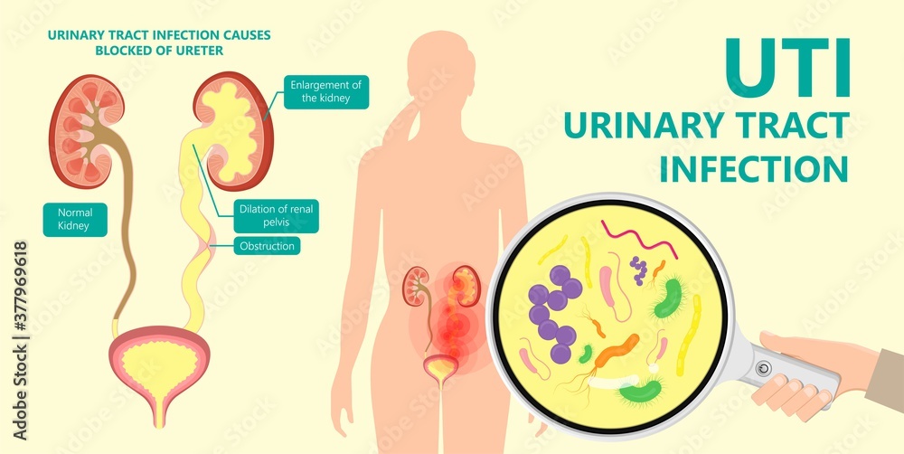 kidney damage UTI scan test tube VCUG acute VUR cyst exam flow pain birth block blood fetal fetus renal stone tract treat tumor urine x-ray cancer defect pelvic pelvis reflux sample system enlarge kidney damage UTI scan test tube VCUG acute VUR cyst exam flow pain birth block blood fetal fetus renal stone tract treat tumor urine x-ray cancer defect pelvic pelvis reflux sample system enlarge