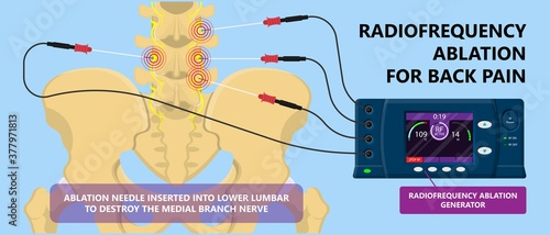 RFA low arm leg hip pain back neck knee pars bone nerve treat joint spine block Local radio needle relief branch Lumbar spinal damage pelvis therapy lateral chronic vertebra cervical surgical medial