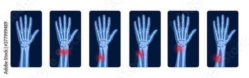 Fracture x ray concept