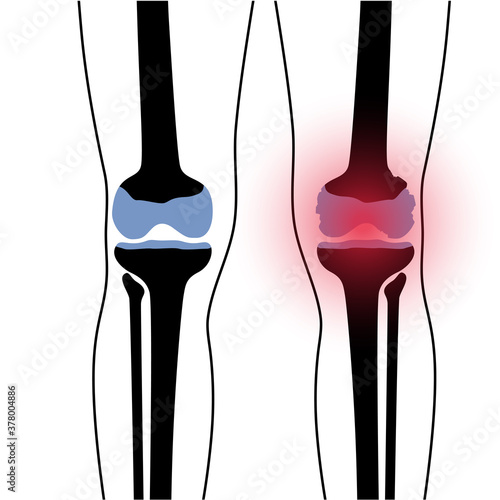 Arthritis in knee joint