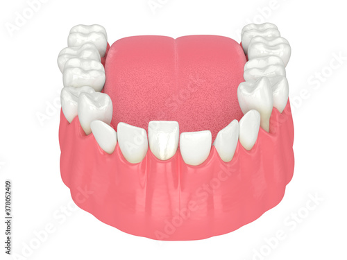3d render of  jaw with abnormal teeth position