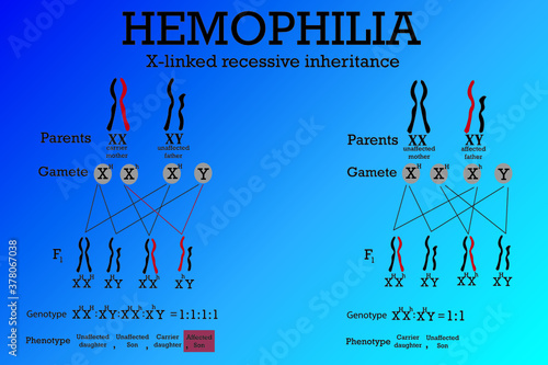 Hemophilia is a genetic disorder  which blood doesn't clot normally because it lacks sufficient blood-clotting proteins (clotting factors).