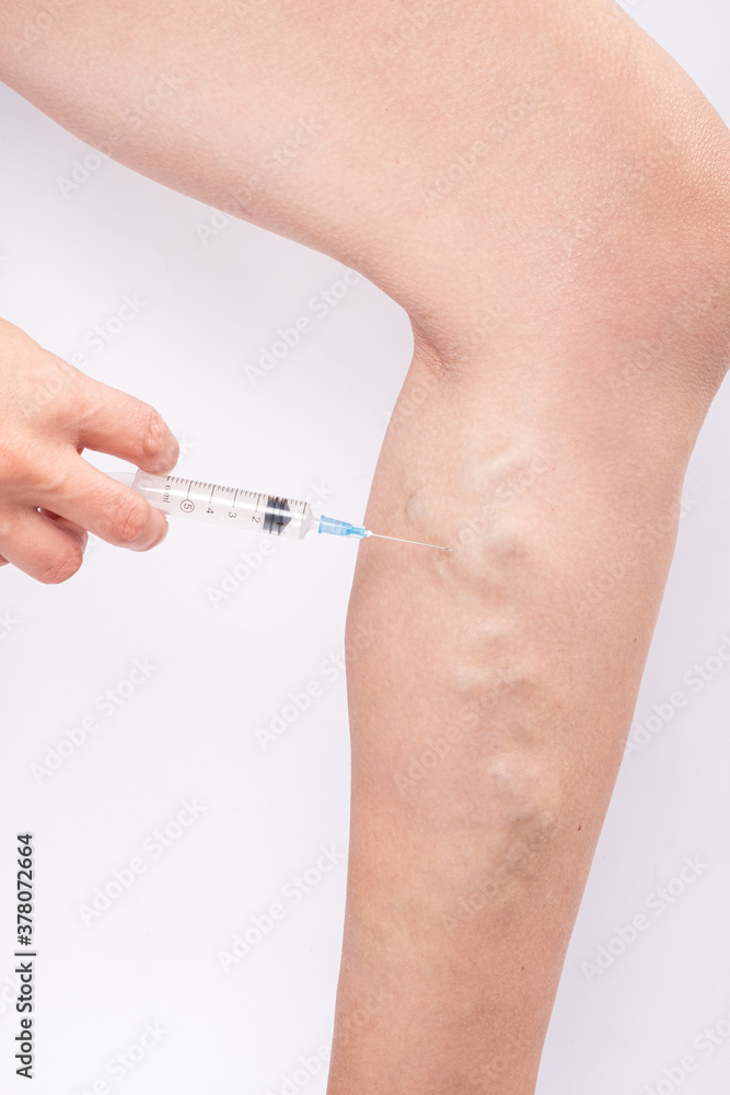 varicose vein treatment, injection into a sore leg
varicose vein treatment, injection into a sore leg