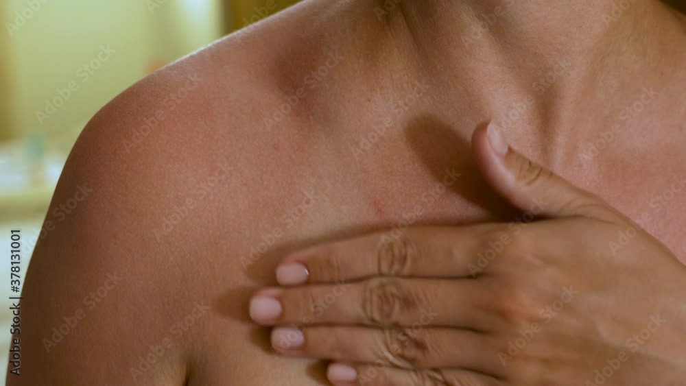 Closeup view 4k video of red sunburnt painful skin of woman after staying for long time under sun light on summer beach. Woman applying body lotion to skin. Closeup view 4k video of red sunburnt painful skin of woman after staying for long time under sun light on summer beach. Woman applying body lotion to skin.