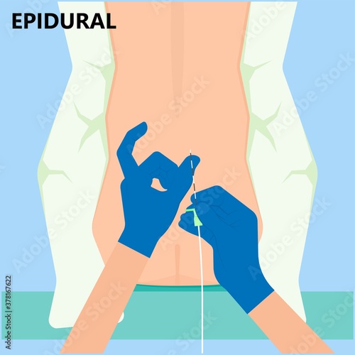 Epidural spinal block anaesthesia Pinched relieve General vaginal medical steroid Natural surgery Walking opioids baby pain back cord birth labor women local spine space relief labour section giving