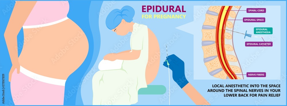 Εκτύπωση καμβά Epidural spinal block anaesthesia Pinched relieve General vaginal medical steroi