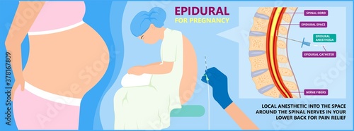 Epidural spinal block anaesthesia Pinched relieve General vaginal medical steroid Natural surgery Walking opioids baby pain back cord birth labor women local spine space relief labour section giving