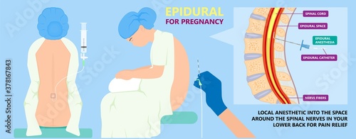 Epidural spinal block anaesthesia Pinched relieve General vaginal medical steroid Natural surgery Walking opioids baby pain back cord birth labor women local spine space relief labour section giving