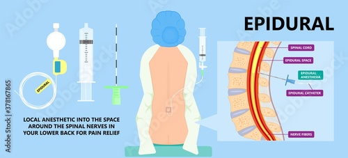 Epidural spinal block anaesthesia Pinched relieve General vaginal medical steroid Natural surgery Walking opioids baby pain back cord birth labor women local spine space relief labour section giving