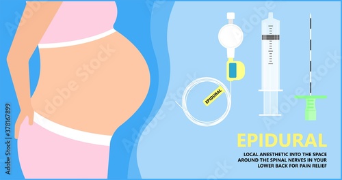 Epidural spinal block anaesthesia Pinched relieve General vaginal medical steroid Natural surgery Walking opioids baby pain back cord birth labor women local spine space relief labour section giving