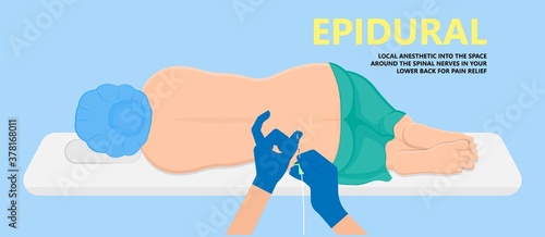 Epidural spinal block anaesthesia Pinched relieve General vaginal medical steroid Natural surgery Walking opioids baby pain back cord birth labor women local spine space relief labour section giving