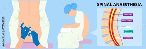 Epidural spinal block anaesthesia Pinched relieve General vaginal medical steroid Natural surgery Walking opioids baby pain back cord birth labor women local spine space relief labour section giving