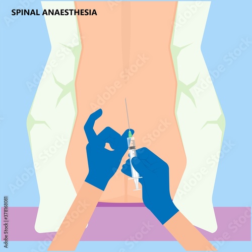 Epidural spinal block anaesthesia Pinched relieve General vaginal medical steroid Natural surgery Walking opioids baby pain back cord birth labor women local spine space relief labour section giving