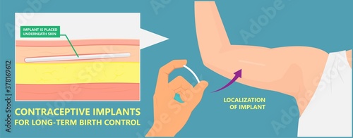 Contraceptive implant premenstrual syndrome family planning infertility counseling stop ovulation fertilization