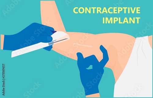Contraceptive implant premenstrual syndrome family planning infertility counseling stop ovulation fertilization