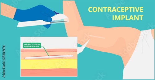 Contraceptive implant premenstrual syndrome family planning infertility counseling stop ovulation fertilization
