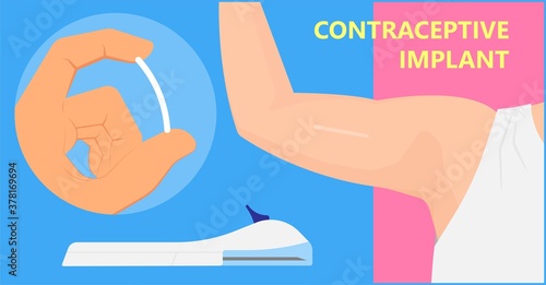 Contraceptive implant premenstrual syndrome family planning infertility counseling stop ovulation fertilization