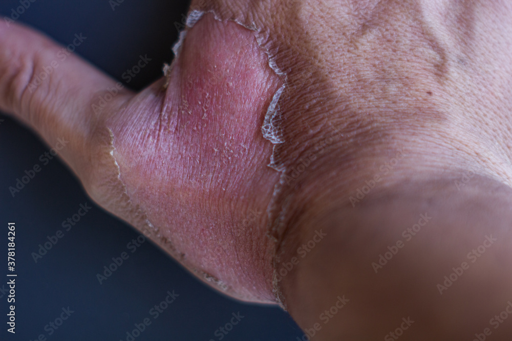 Fototapeta premium hand of a person, burned skin, 1st grade burn
