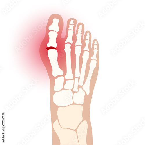Arthritis foot concept