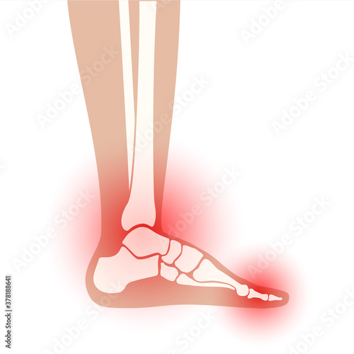 Arthritis foot concept