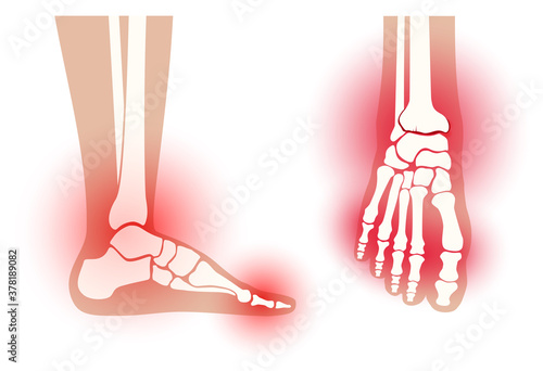 Arthritis foot concept