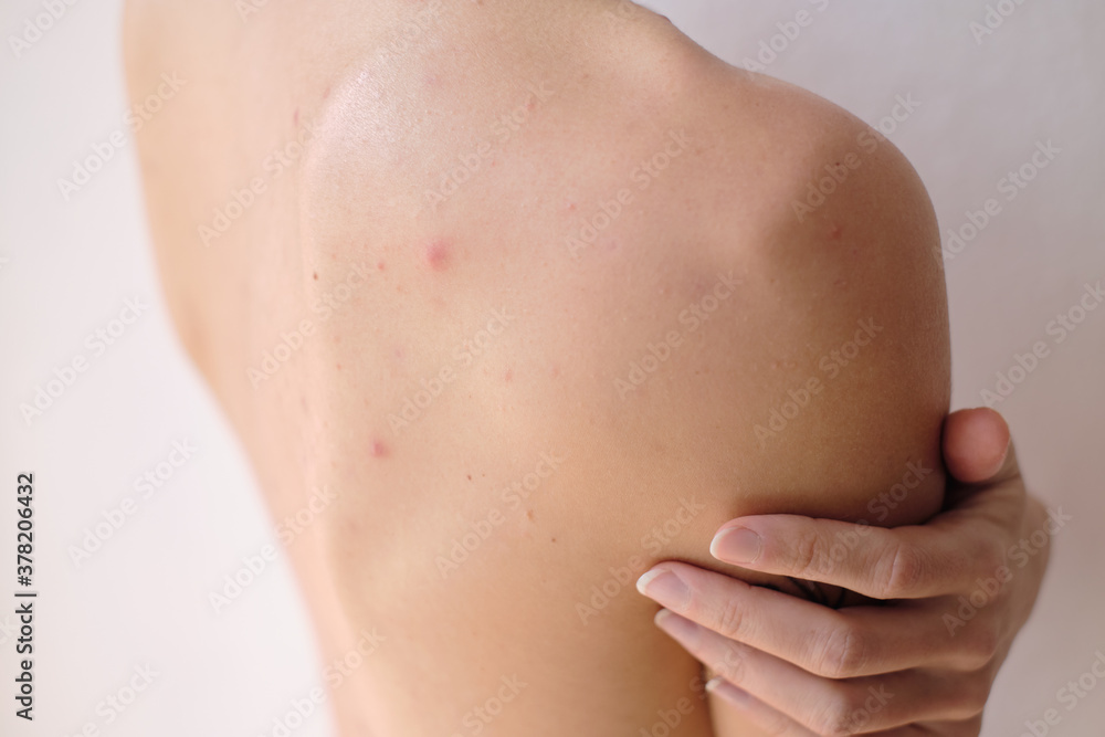 Nude woman skin problems acne closeup shot Nude woman skin problems acne closeup shot